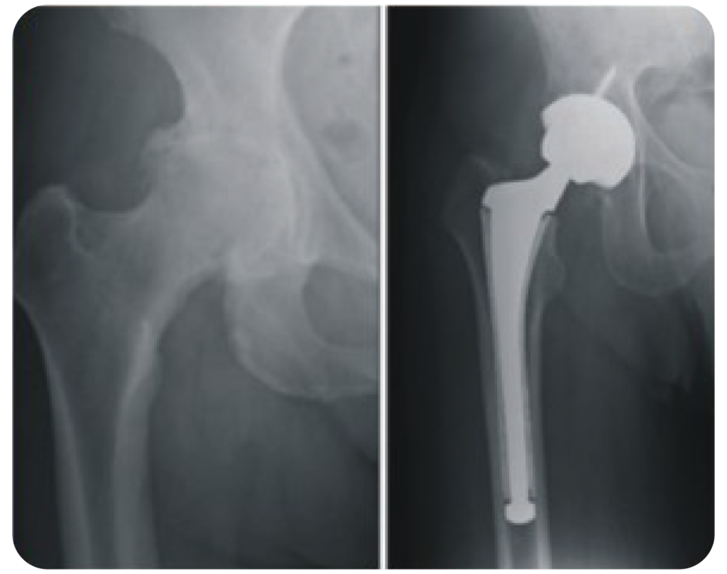 Hip Replacment