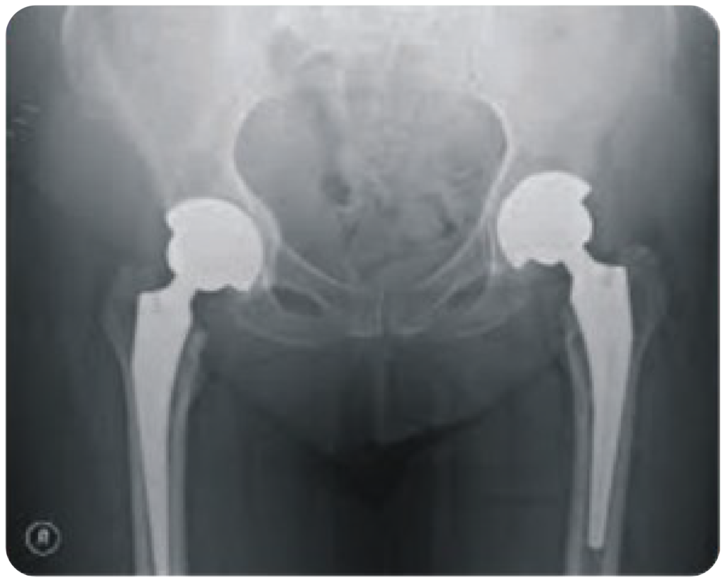 Hip Replacment