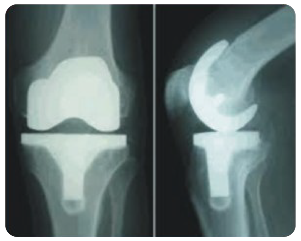 Knee Replacement