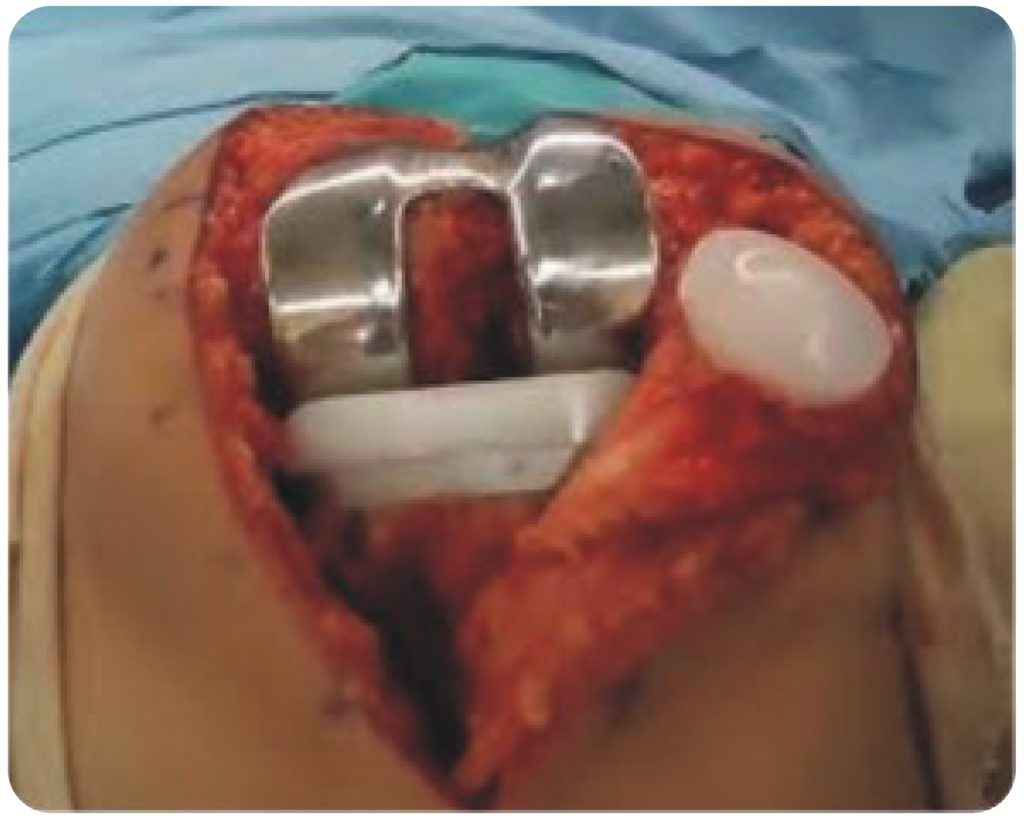Knee Replacement