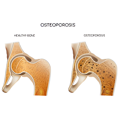 Osteoporosis