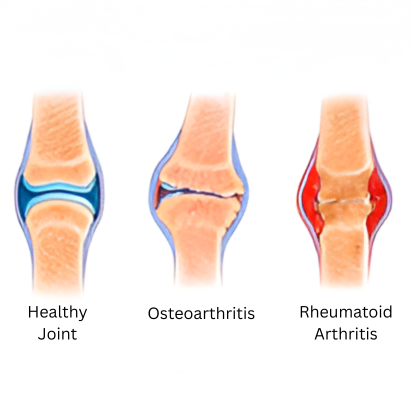 Arthritis