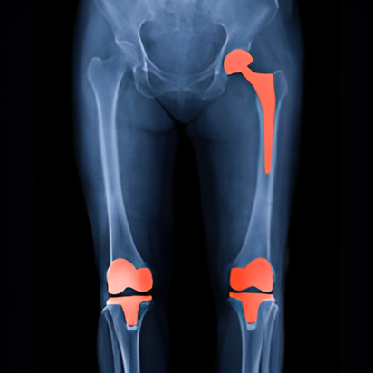 Hip & Knee Replacement
